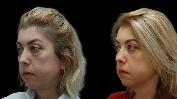 Lower Eyelid Surgery Before & After Gallery - Patient 266143 - Image 1