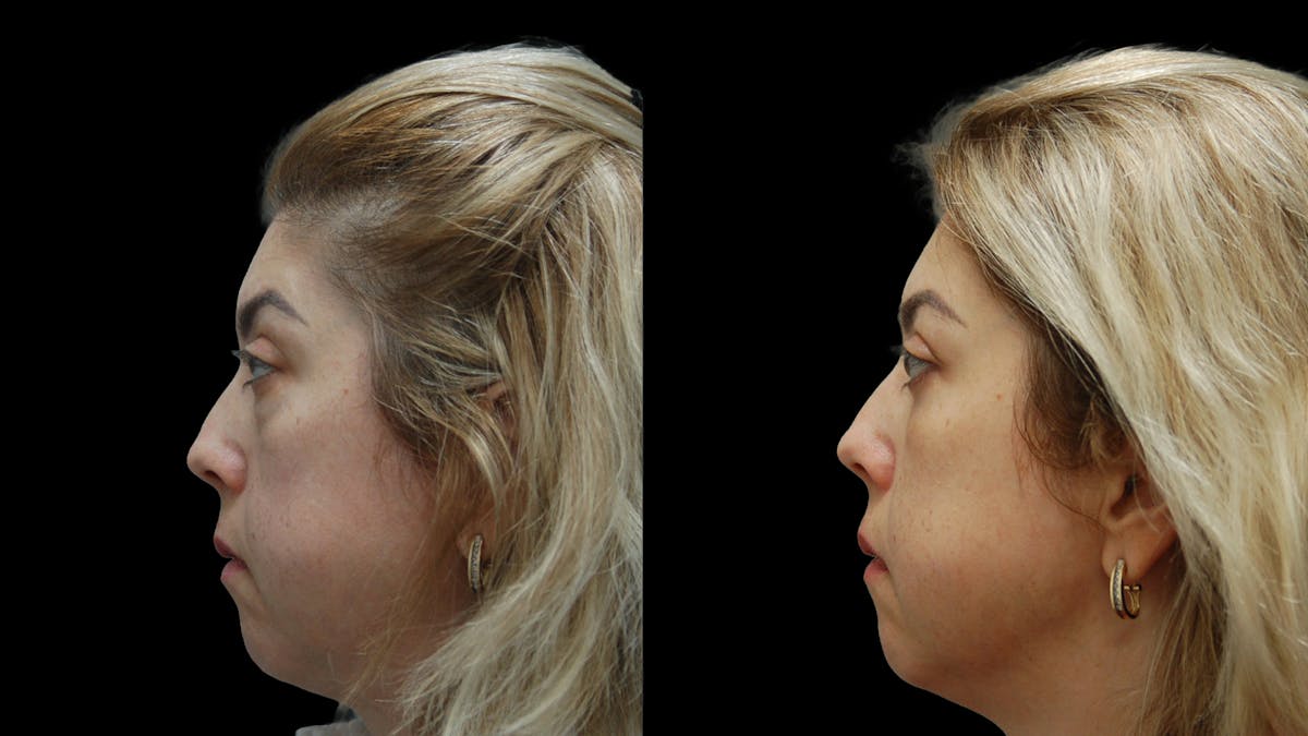 Lower Eyelid Surgery Before & After Gallery - Patient 266143 - Image 3