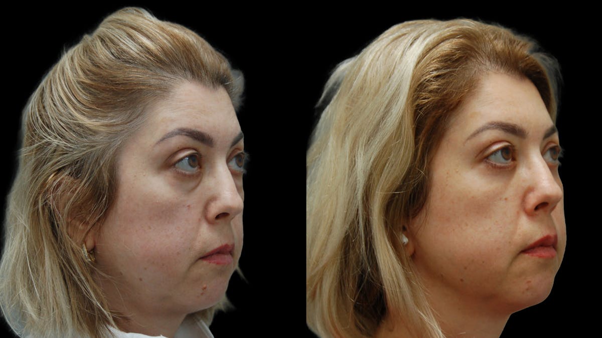 Lower Eyelid Surgery Before & After Gallery - Patient 266143 - Image 4