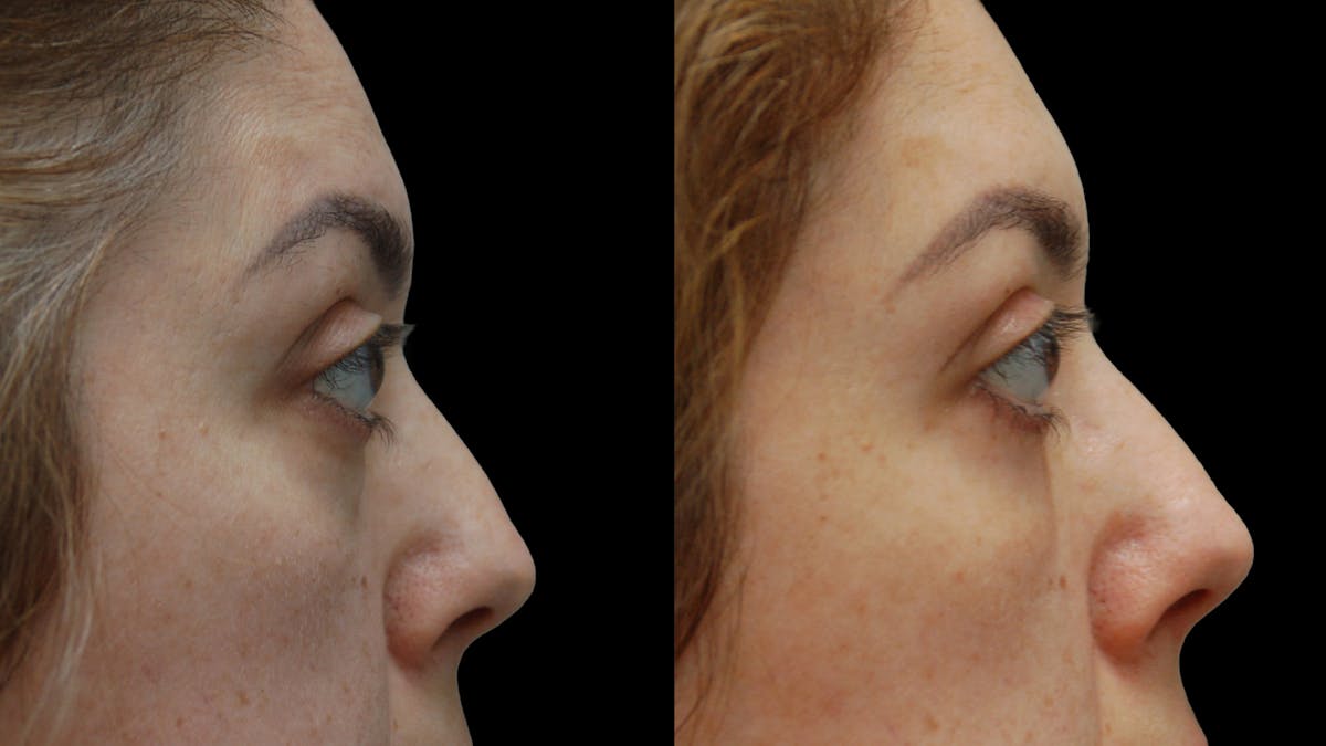 Lower Eyelid Surgery Before & After Gallery - Patient 266143 - Image 6