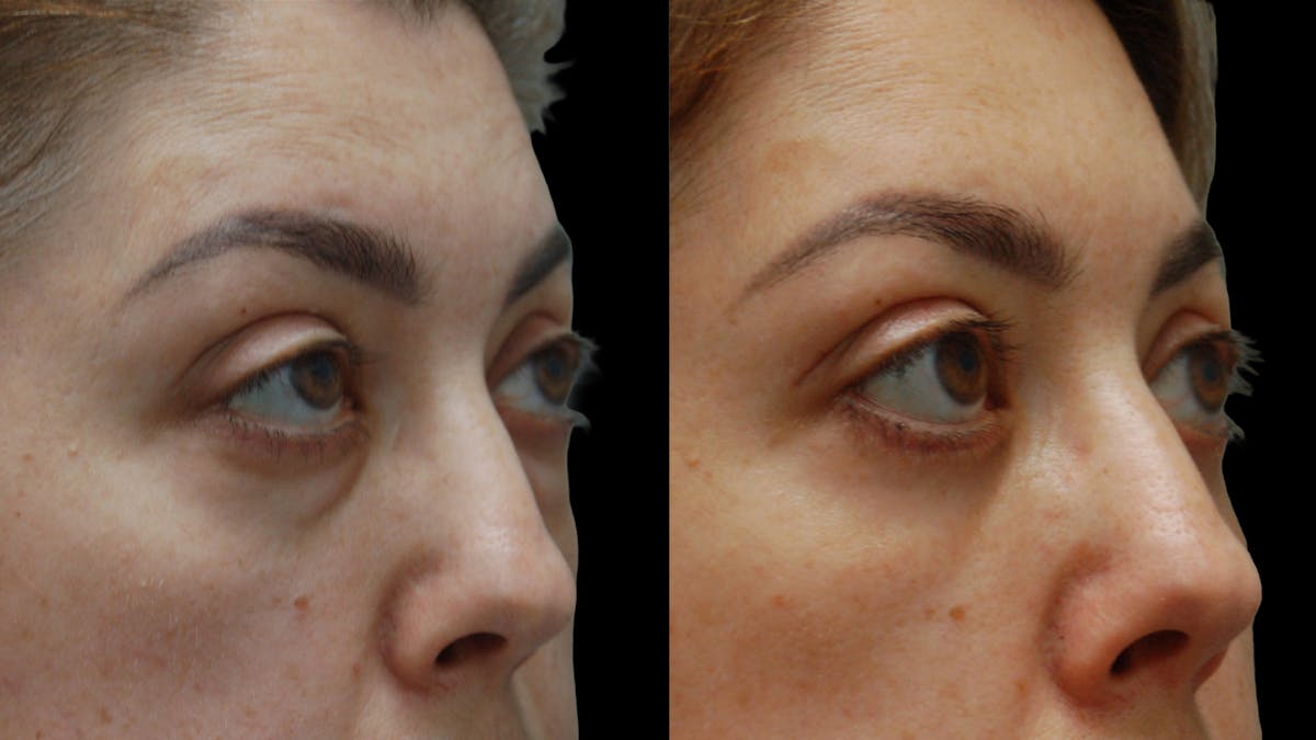 Lower Eyelid Surgery Before & After Gallery - Patient 266143 - Image 11