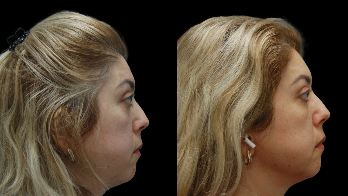 Lower Eyelid Surgery Before & After Gallery - Patient 266143 - Image 5