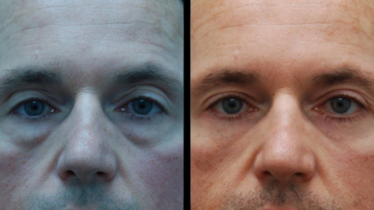 Lower Eyelid Surgery Before & After Gallery - Patient 300160 - Image 1