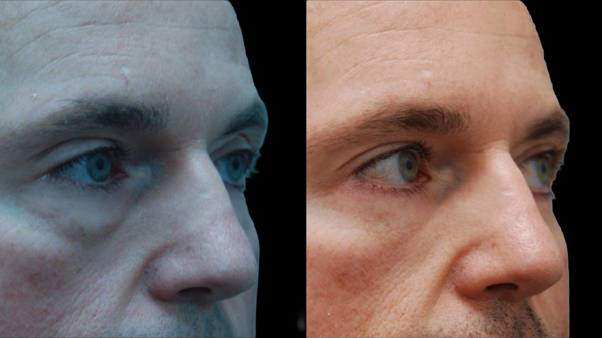 Lower Eyelid Surgery Before & After Gallery - Patient 300160 - Image 2