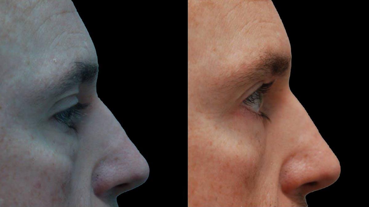 Lower Eyelid Surgery Before & After Gallery - Patient 300160 - Image 3