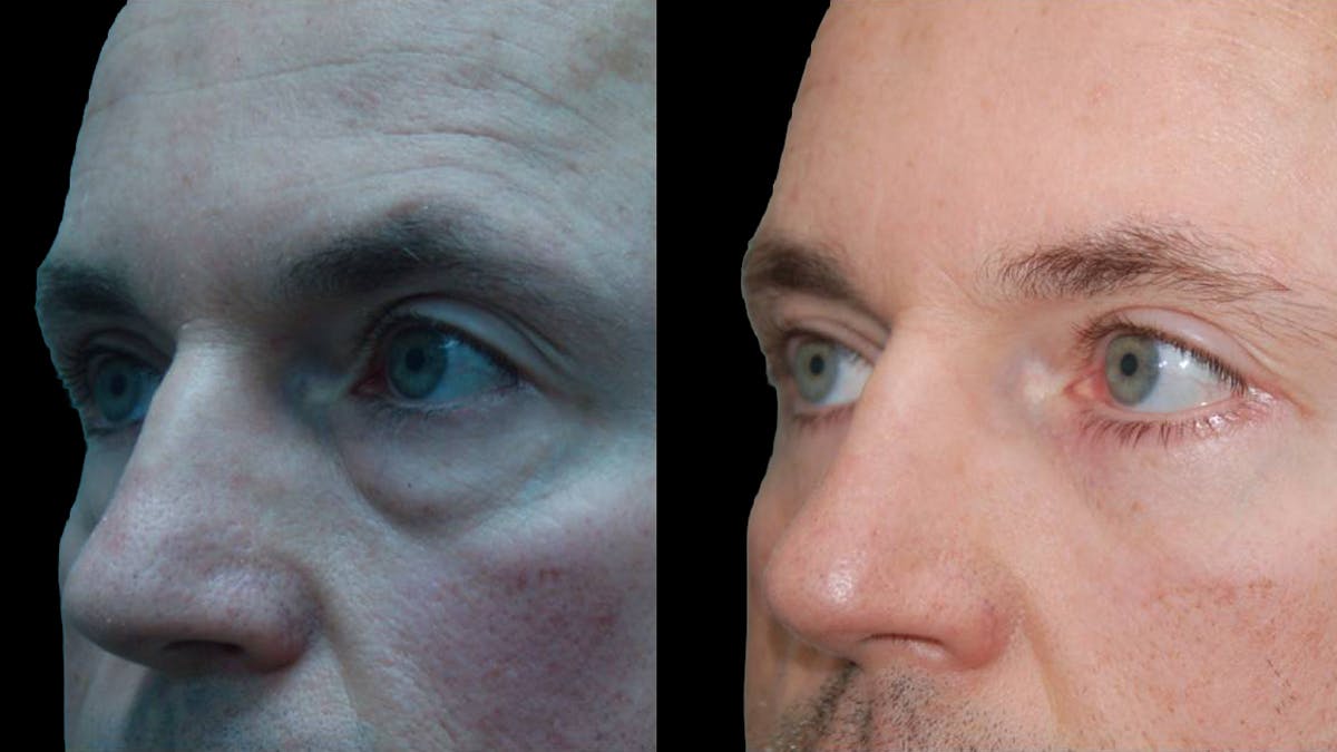 Lower Eyelid Surgery Before & After Gallery - Patient 300160 - Image 4