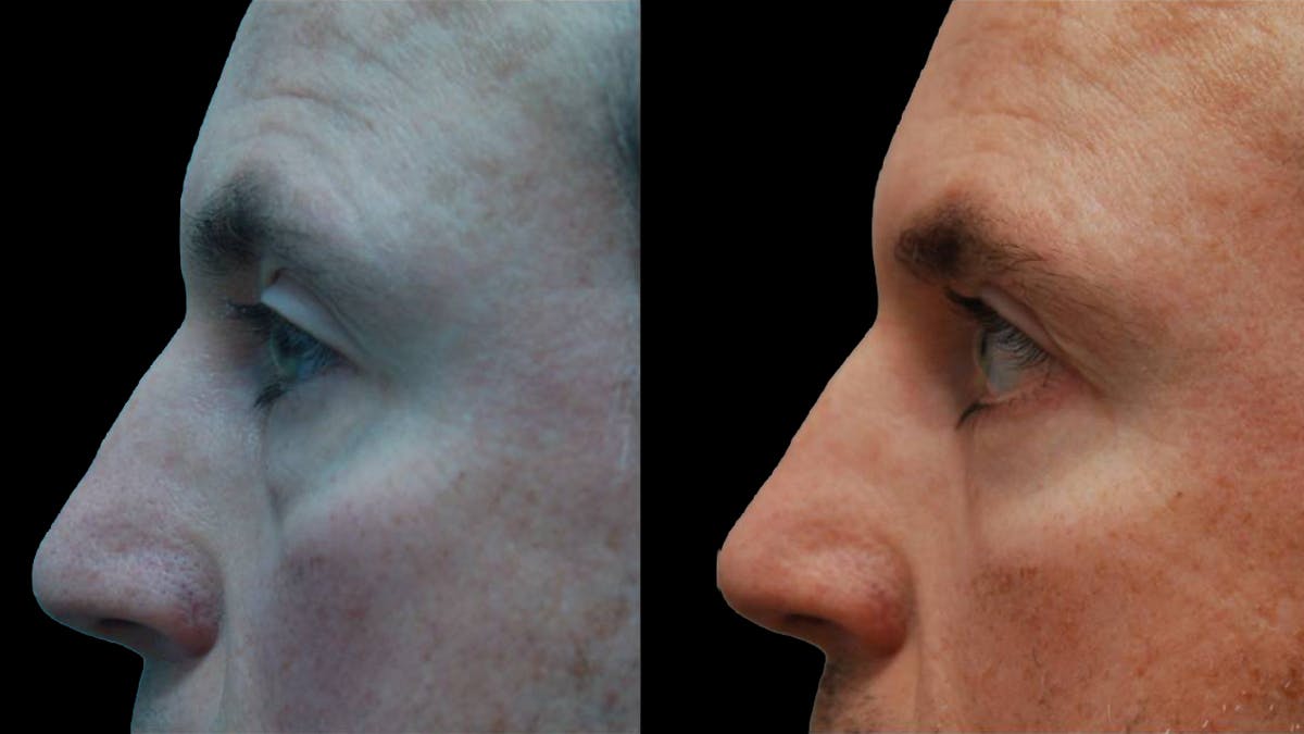 Lower Eyelid Surgery Before & After Gallery - Patient 300160 - Image 5