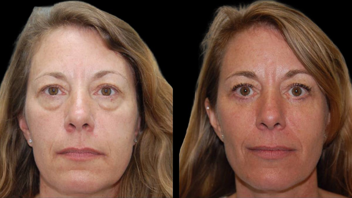 Lower Eyelid Surgery Before & After Gallery - Patient 523512 - Image 2