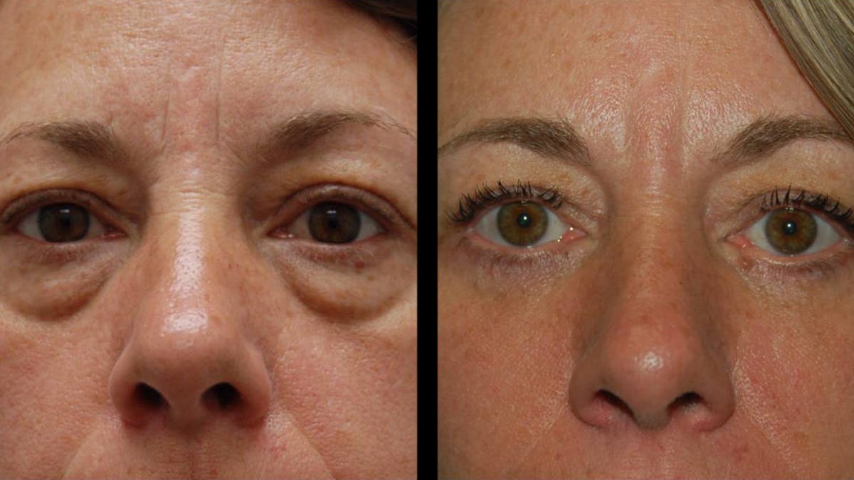 Lower Eyelid Surgery Before & After Gallery - Patient 523512 - Image 3
