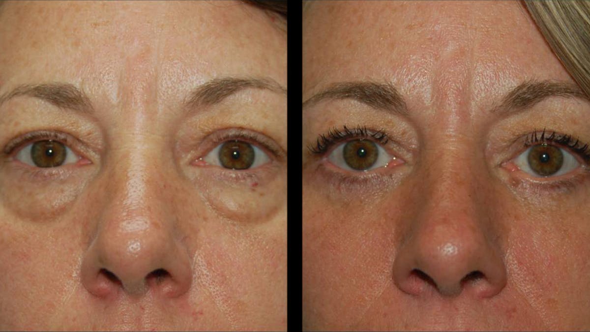 Lower Eyelid Surgery Before & After Gallery - Patient 523512 - Image 4