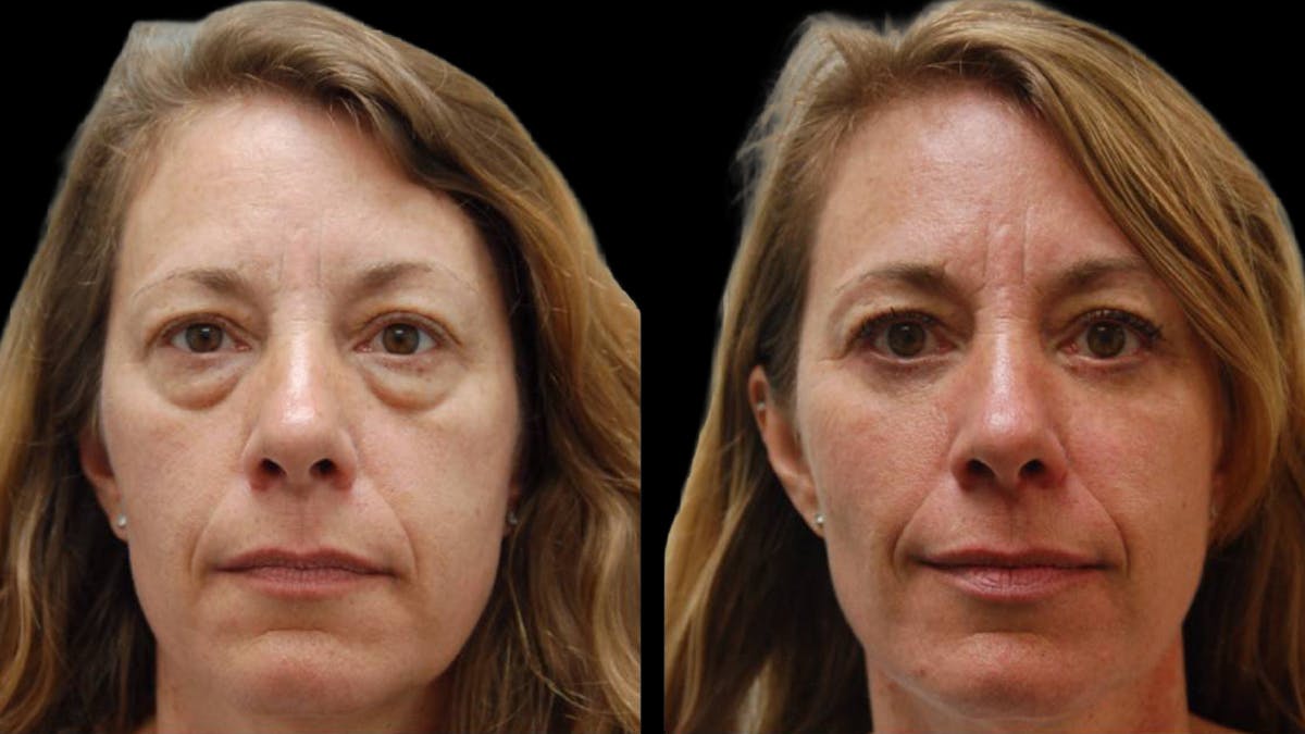 Lower Eyelid Surgery Before & After Gallery - Patient 523512 - Image 5
