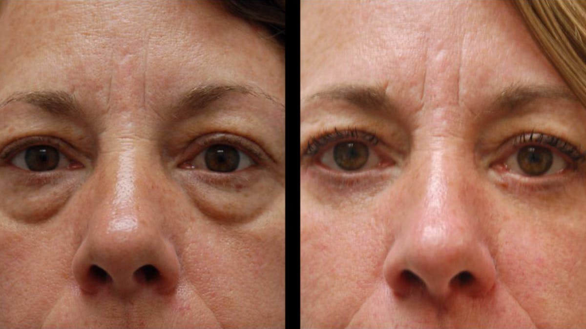 Lower Eyelid Surgery Before & After Gallery - Patient 523512 - Image 6