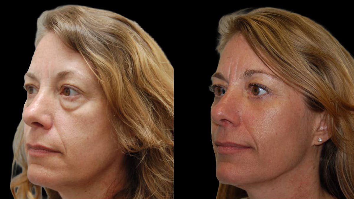Lower Eyelid Surgery Before & After Gallery - Patient 523512 - Image 1