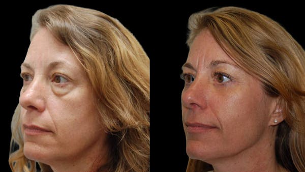 Lower Eyelid Surgery Before & After Gallery - Patient 523512 - Image 1