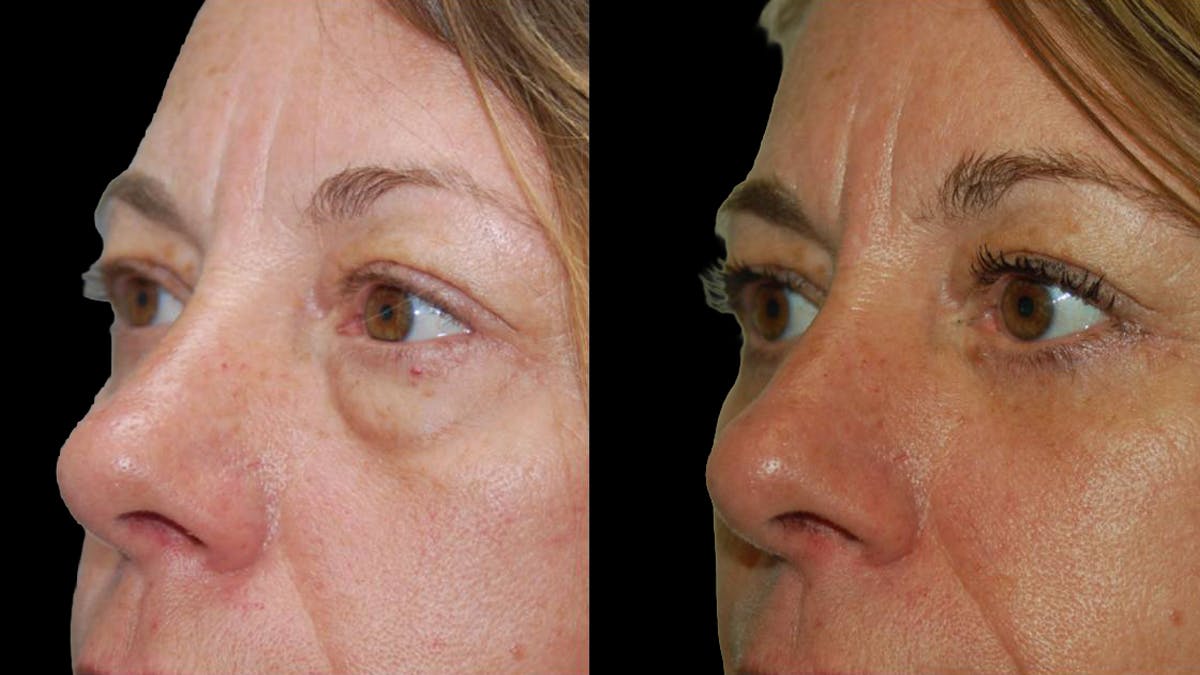 Lower Eyelid Surgery Before & After Gallery - Patient 523512 - Image 7