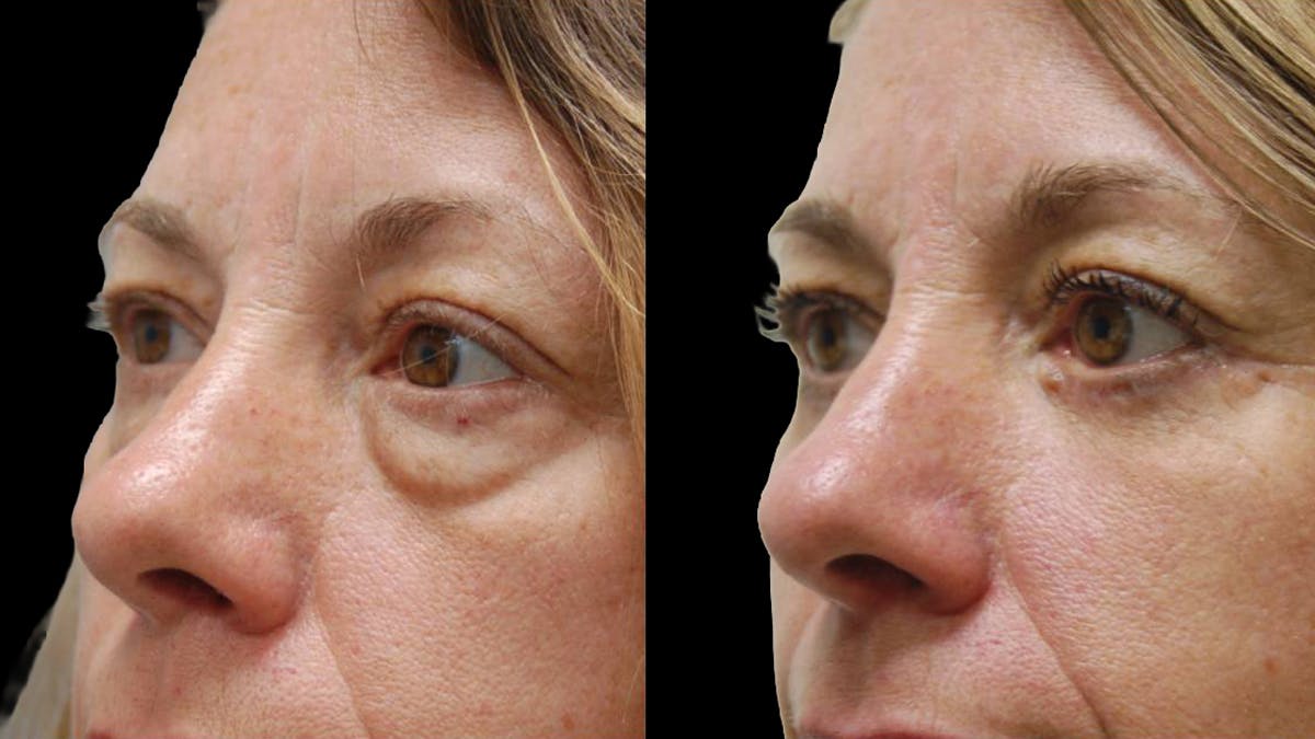 Lower Eyelid Surgery Before & After Gallery - Patient 523512 - Image 8