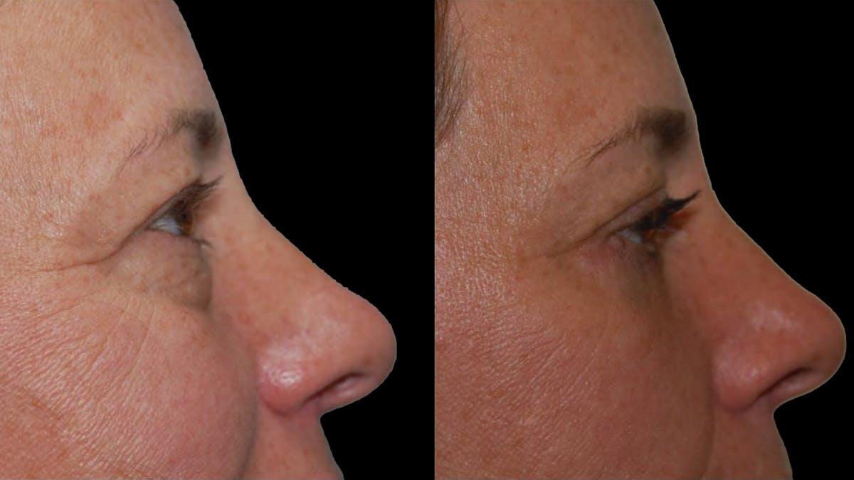 Lower Eyelid Surgery Before & After Gallery - Patient 523512 - Image 9