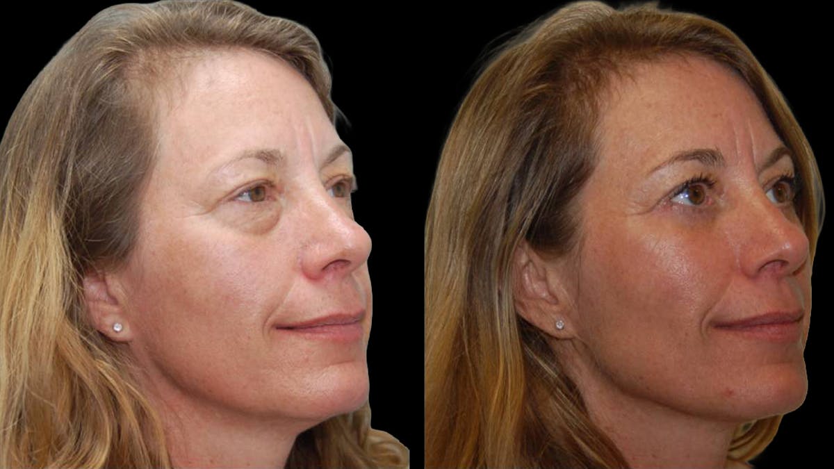 Lower Eyelid Surgery Before & After Gallery - Patient 523512 - Image 10
