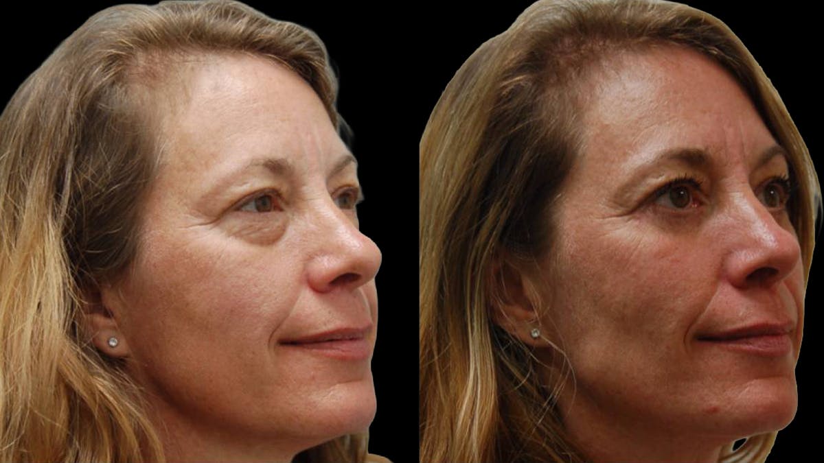 Lower Eyelid Surgery Before & After Gallery - Patient 523512 - Image 11