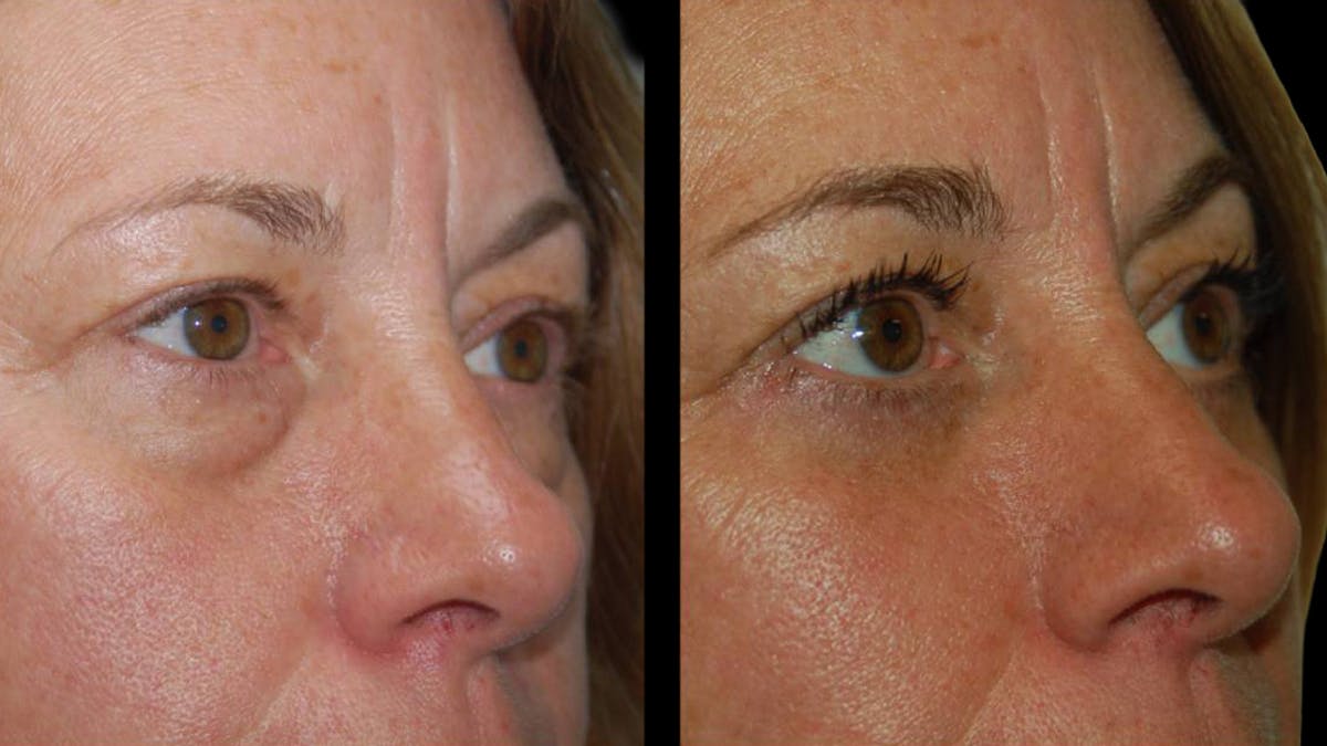 Lower Eyelid Surgery Before & After Gallery - Patient 523512 - Image 12