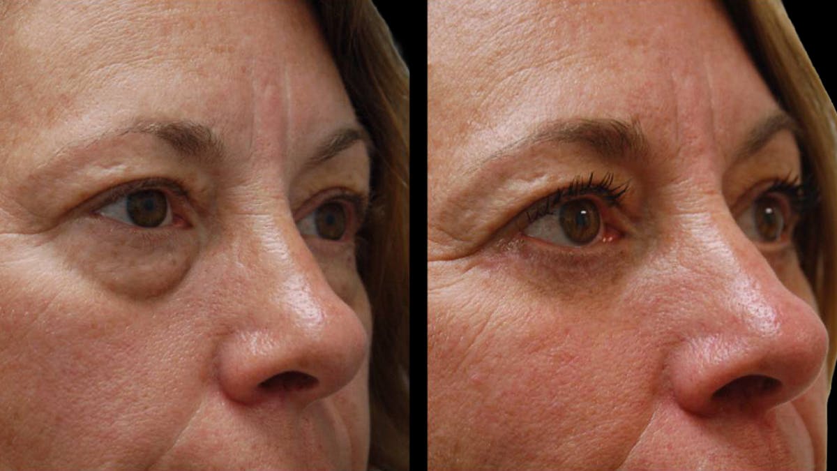 Lower Eyelid Surgery Before & After Gallery - Patient 523512 - Image 13