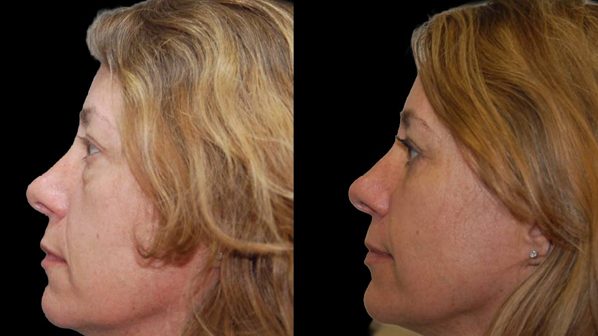 Lower Eyelid Surgery Before & After Gallery - Patient 523512 - Image 14