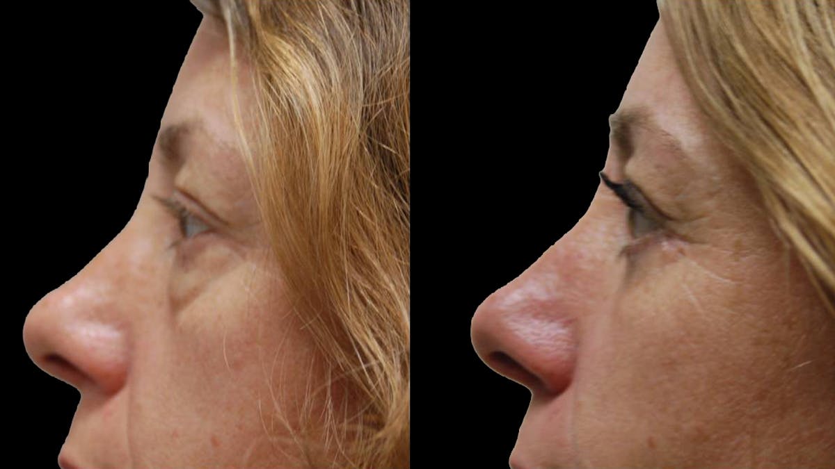 Lower Eyelid Surgery Before & After Gallery - Patient 523512 - Image 15