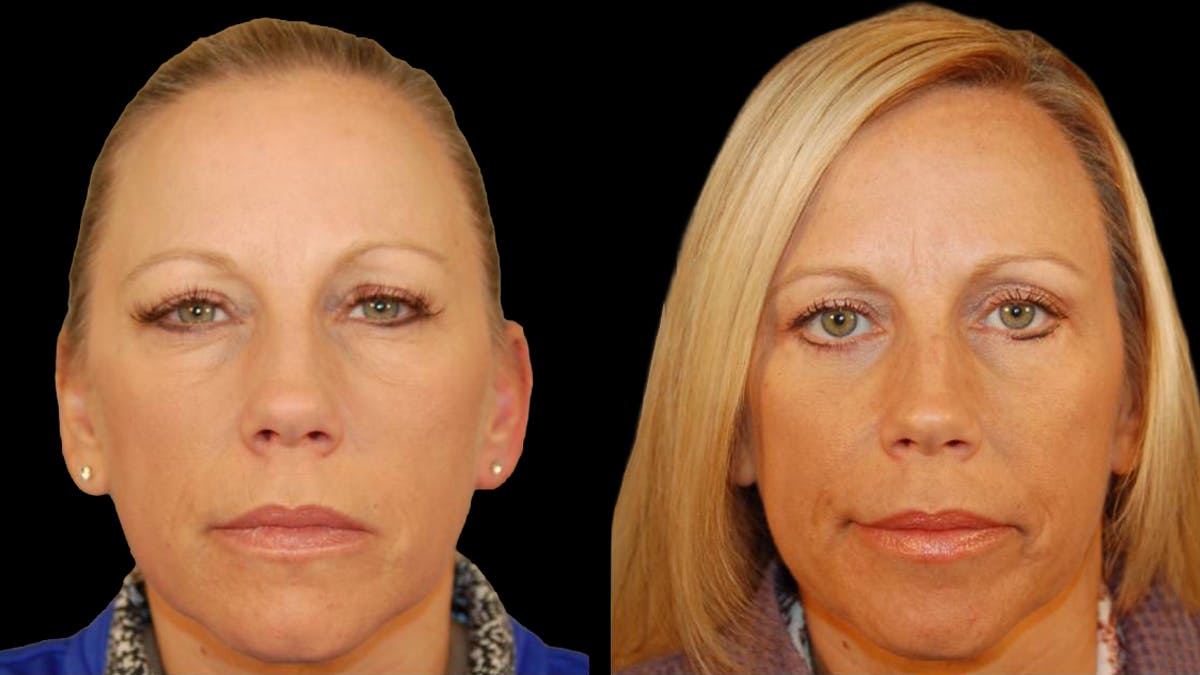 Lower Eyelid Surgery Before & After Gallery - Patient 340536 - Image 2