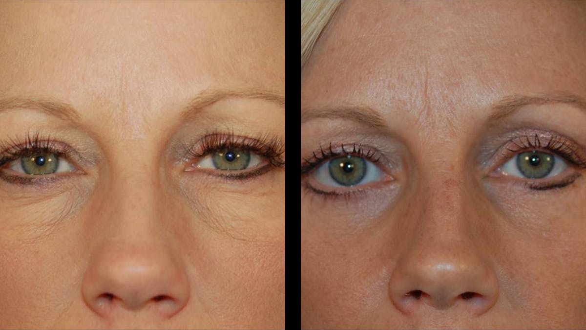 Lower Eyelid Surgery Before & After Gallery - Patient 340536 - Image 3