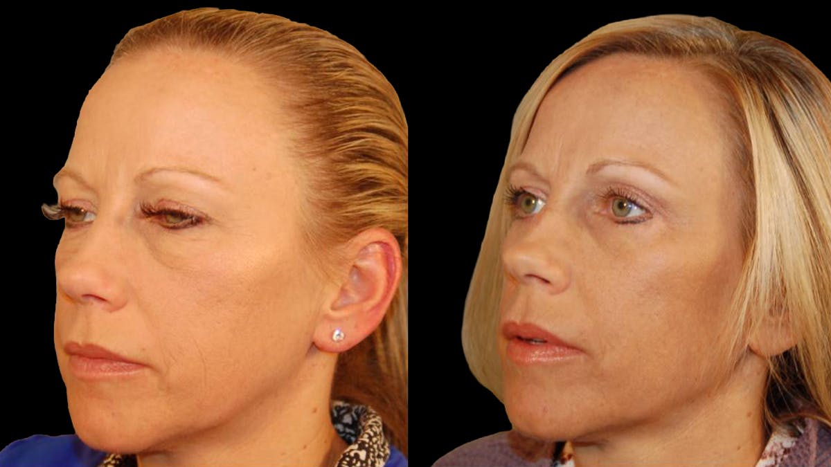 Lower Eyelid Surgery Before & After Gallery - Patient 340536 - Image 1