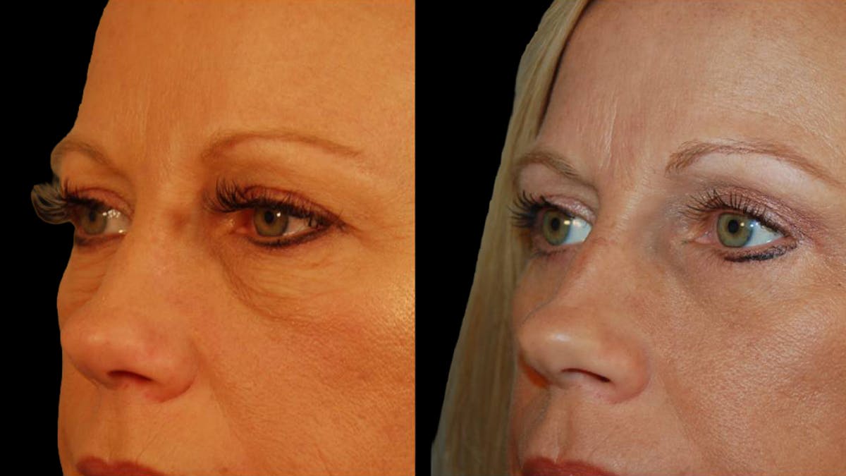 Lower Eyelid Surgery Before & After Gallery - Patient 340536 - Image 4