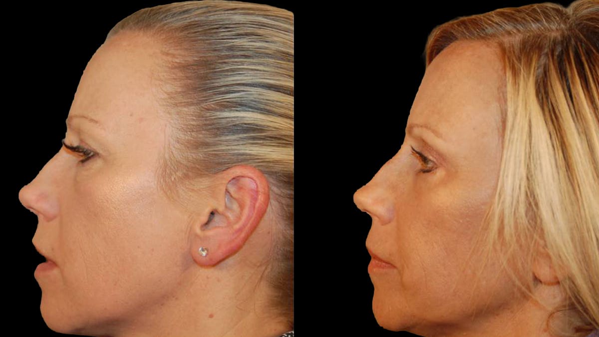 Lower Eyelid Surgery Before & After Gallery - Patient 340536 - Image 5