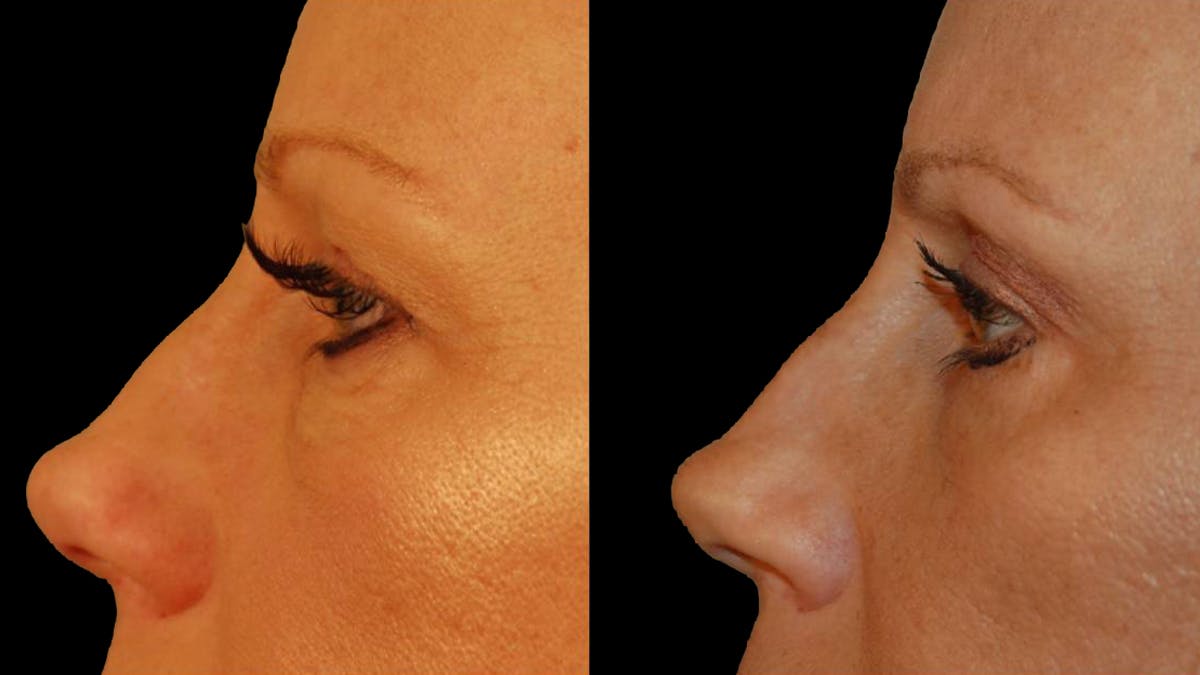 Lower Eyelid Surgery Before & After Gallery - Patient 340536 - Image 6