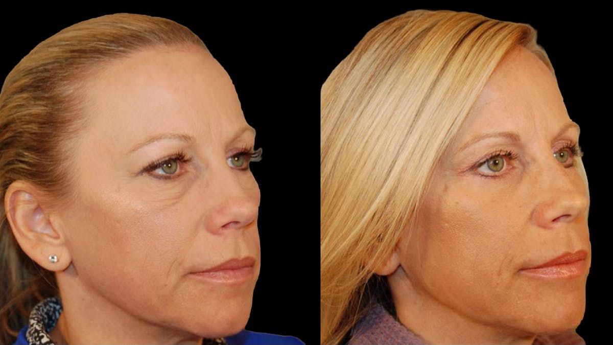 Lower Eyelid Surgery Before & After Gallery - Patient 340536 - Image 7