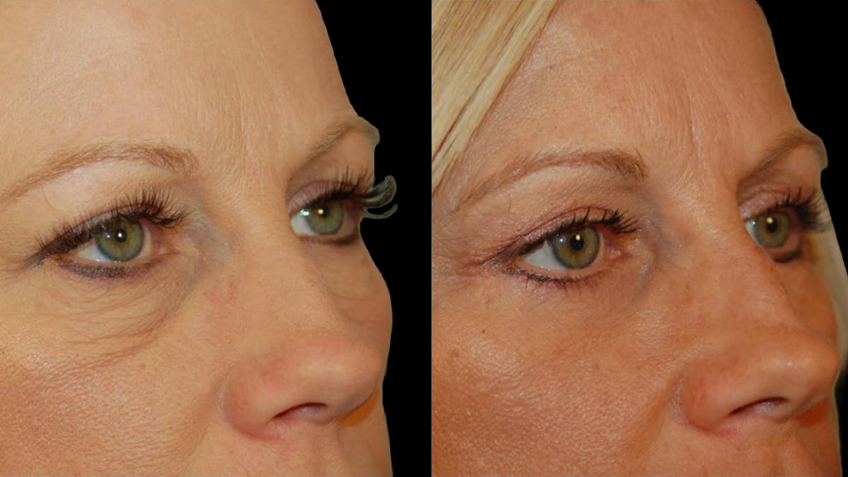 Lower Eyelid Surgery Before & After Gallery - Patient 340536 - Image 8