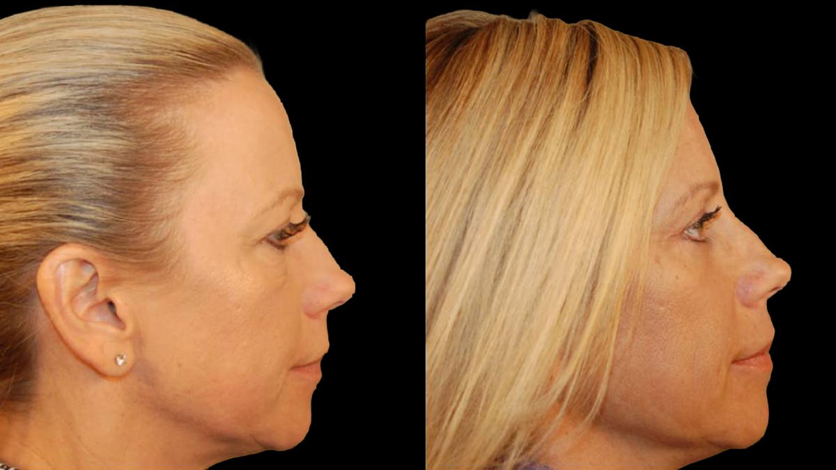 Lower Eyelid Surgery Before & After Gallery - Patient 340536 - Image 9