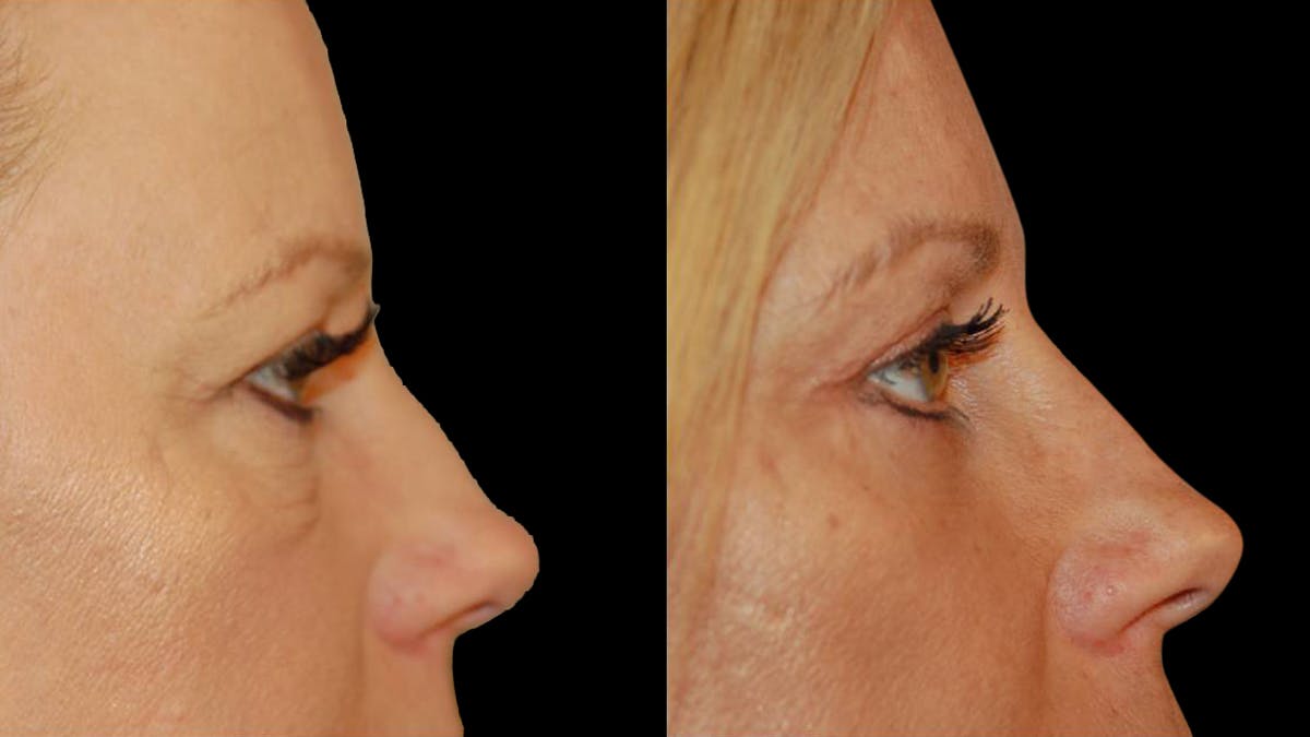 Lower Eyelid Surgery Before & After Gallery - Patient 340536 - Image 10