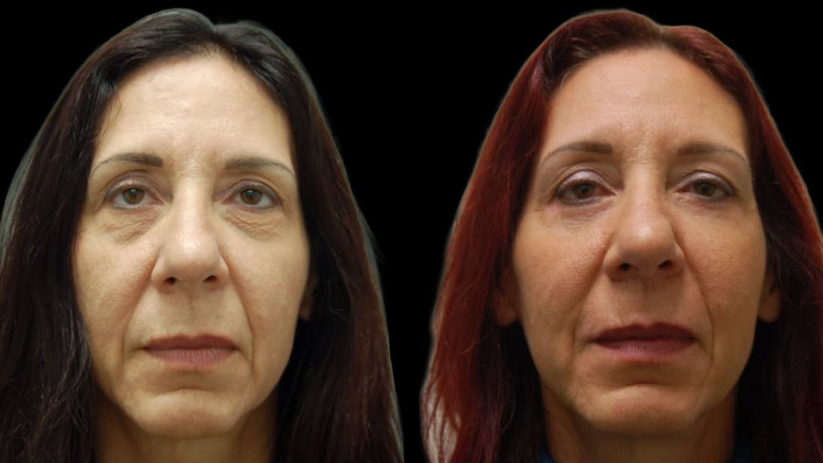 Lower Eyelid Surgery Before & After Gallery - Patient 186833 - Image 2