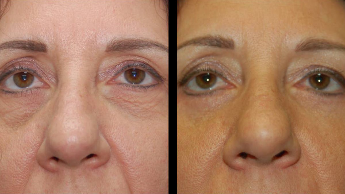 Lower Eyelid Surgery Before & After Gallery - Patient 186833 - Image 6