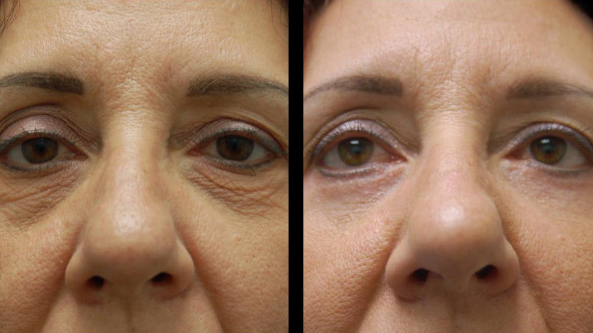 Lower Eyelid Surgery Before & After Gallery - Patient 186833 - Image 7