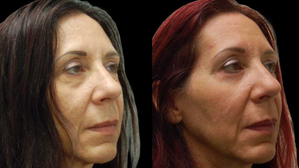 Lower Eyelid Surgery Before & After Gallery - Patient 186833 - Image 4