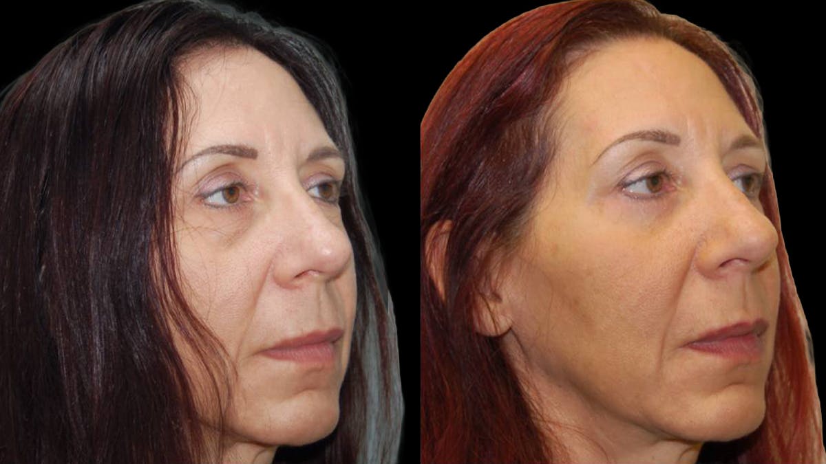 Lower Eyelid Surgery Before & After Gallery - Patient 186833 - Image 3