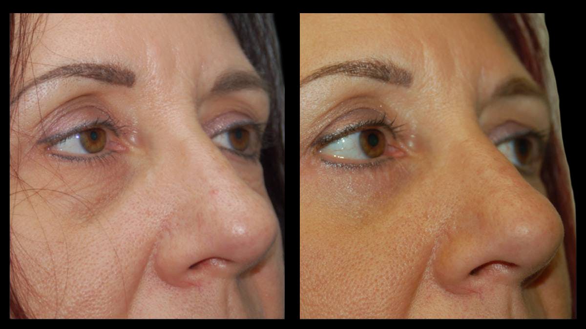 Lower Eyelid Surgery Before & After Gallery - Patient 186833 - Image 8