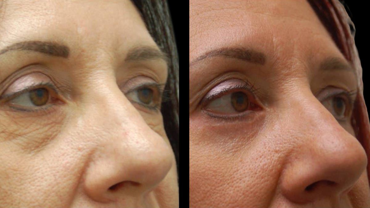 Lower Eyelid Surgery Before & After Gallery - Patient 186833 - Image 9
