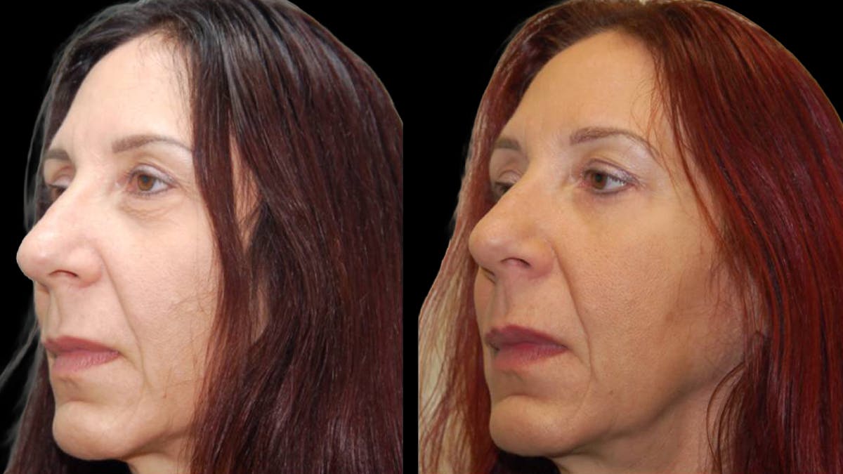 Lower Eyelid Surgery Before & After Gallery - Patient 186833 - Image 1