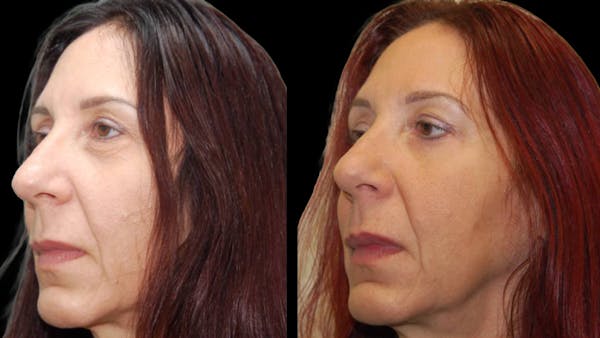 Lower Eyelid Surgery Before & After Gallery - Patient 186833 - Image 1