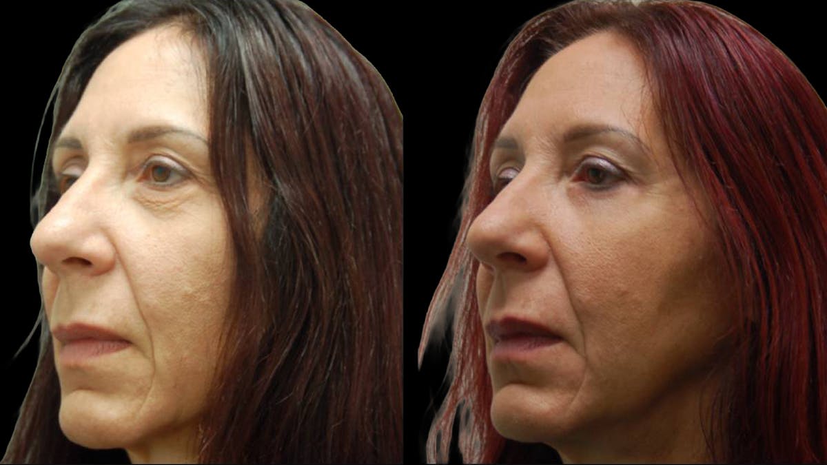 Lower Eyelid Surgery Before & After Gallery - Patient 186833 - Image 5