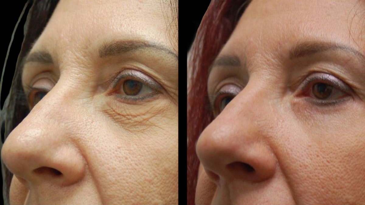 Lower Eyelid Surgery Before & After Gallery - Patient 186833 - Image 10