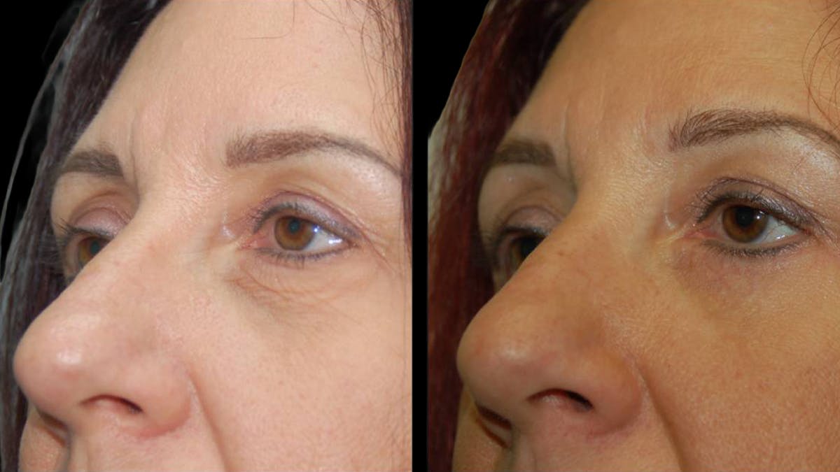 Lower Eyelid Surgery Before & After Gallery - Patient 186833 - Image 11