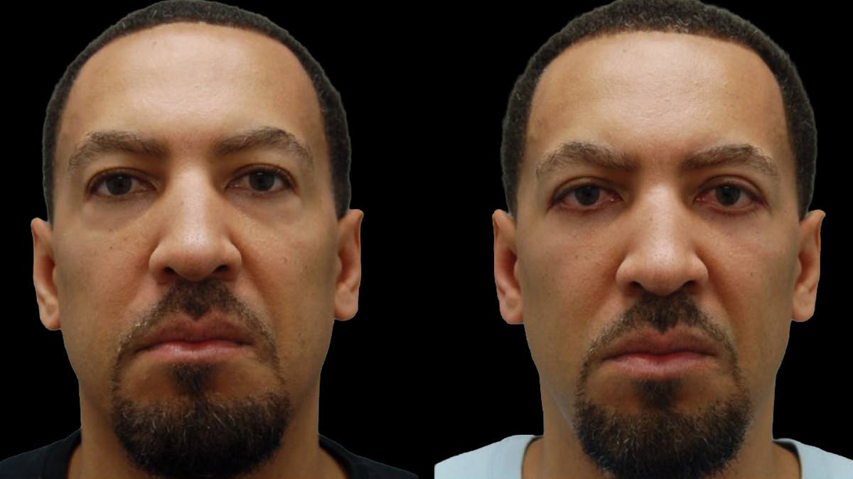 Lower Eyelid Surgery Before & After Gallery - Patient 399063 - Image 2
